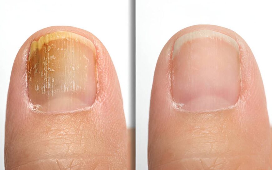 Is Toenail Fungus Contagious? Tips to Protect Your Feet
